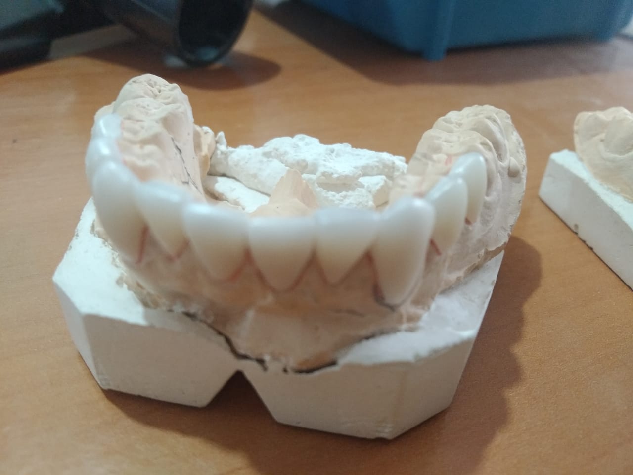 Facettes esthétiques 35–45